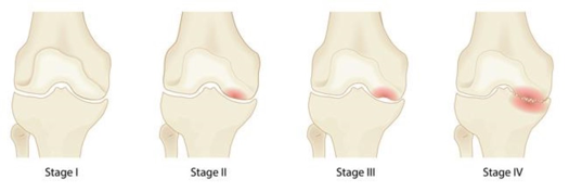 knee stages