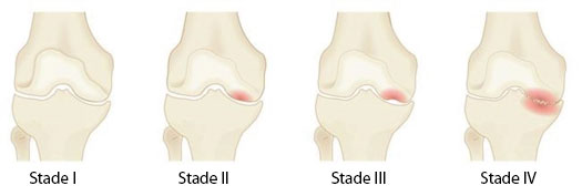 knee stages