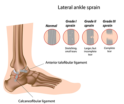 ankle sprain