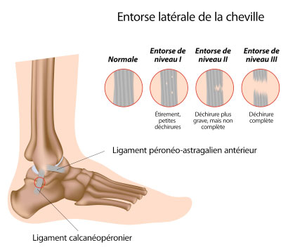 ankle sprain