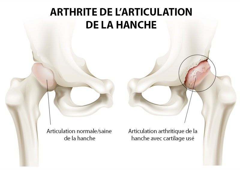 Hip Joint