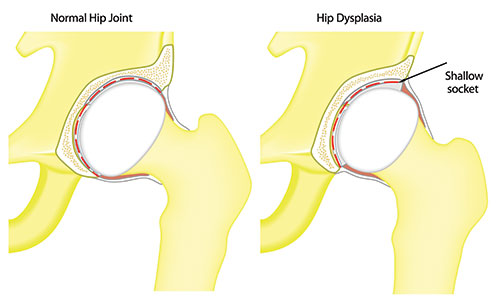 Normal hip vs hip displasia