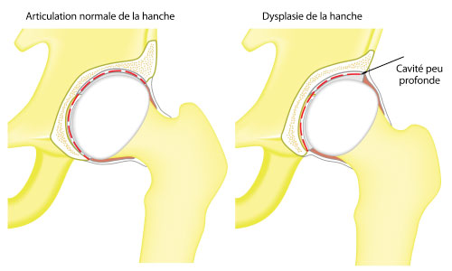 Normal hip vs hip displasia