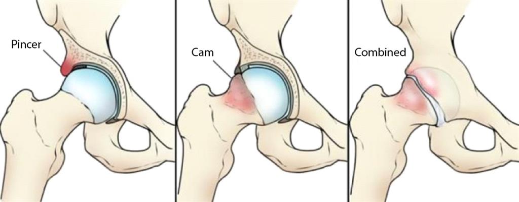 Pincer, Cam and Combined FAI graphic