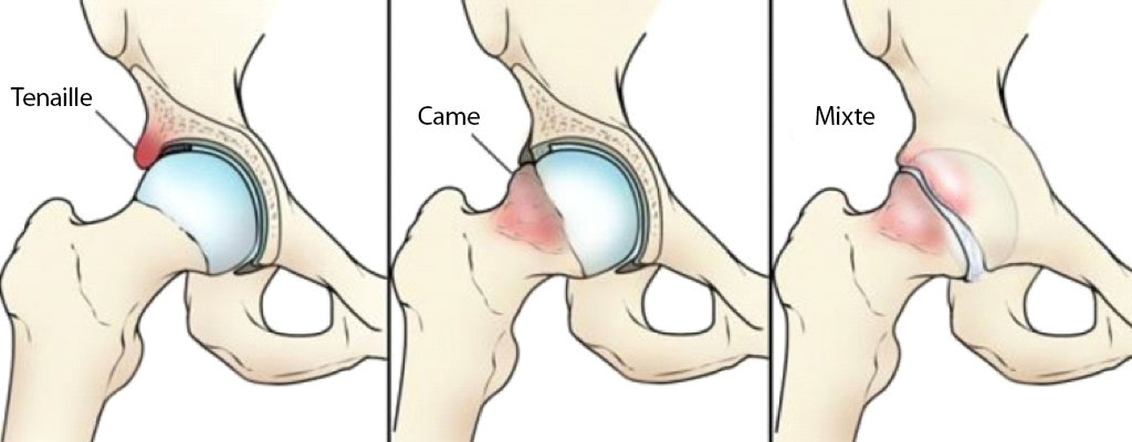 Pincer, Cam and Combined FAI graphic