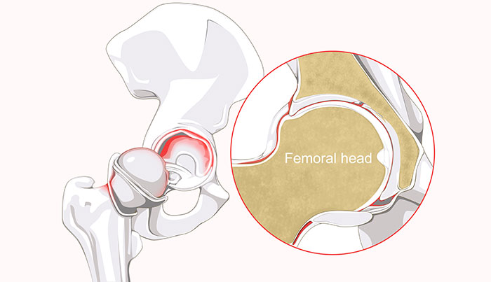 Hip labral tear and femoral head