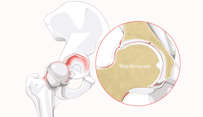 Hip labral tear and femoral head