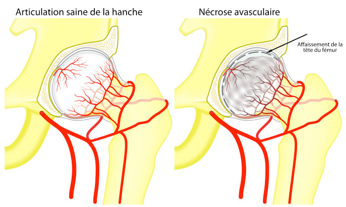 Healthy Hip Joint vs Avascular necrosis